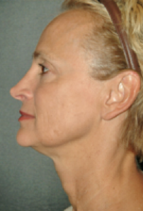 Facelift Before