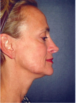 Facelift Before