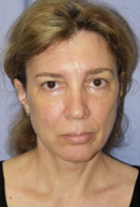 Facelift Before