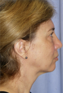 Facelift Before