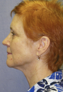 Facelift Before