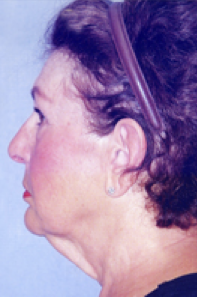 Facelift Before