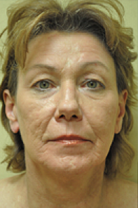 Facelift Before