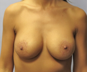 Breast Implants with Lift After