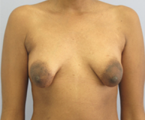 Breast Implants with Lift Before