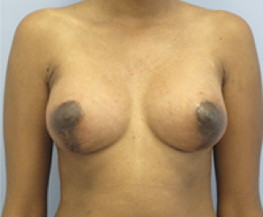 Breast Implants with Lift After