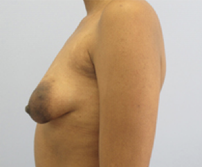 Breast Implants with Lift Before