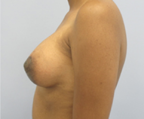 Breast Implants with Lift After