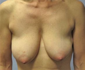 Breast Implants with Lift Before