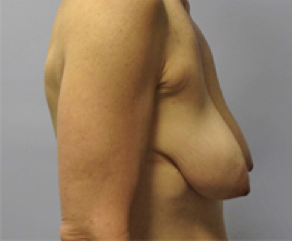 Breast Implants with Lift Before