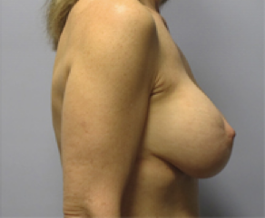 Breast Implants with Lift After