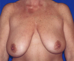 Breast Implants with Lift Before