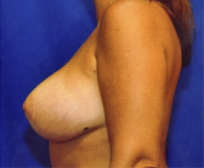 Breast Implants with Lift After