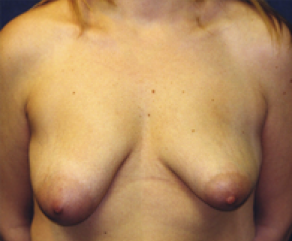 Breast Lift Before