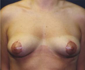 Breast Lift After