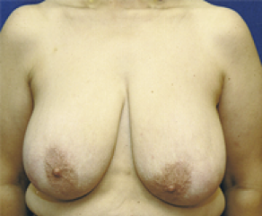 Breast Lift Before