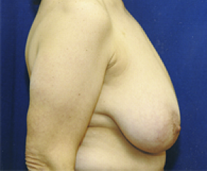 Breast Lift Before