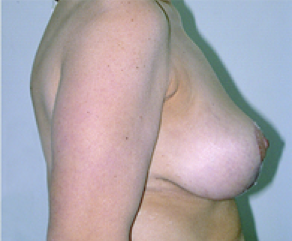 Breast Lift After