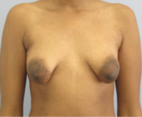 Tubular Breast Syndrome Before