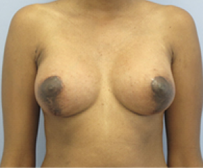 Tubular Breast Syndrome After