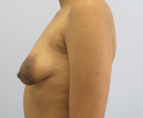 Tubular Breast Syndrome Before