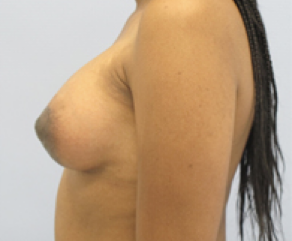 Tubular Breast Syndrome After