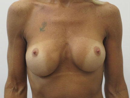 Breast Implant Replacement Before