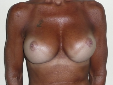 Breast Implant Replacement After