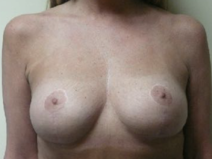 Breast Implant Replacement After