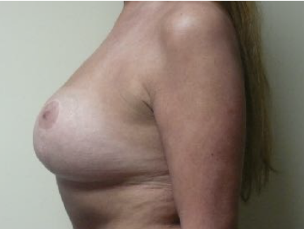 Breast Implant Replacement After