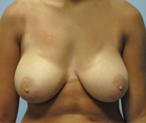 Breast Reduction Before