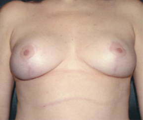 Breast Reduction After