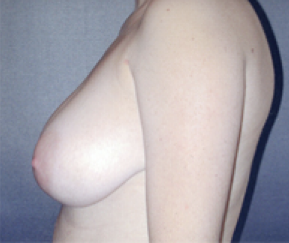 Breast Reduction Before