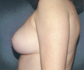 Breast Reduction After