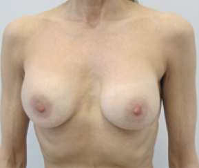 Breast Explant Before