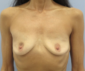 Breast Explant After