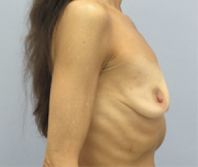 Breast Explant After