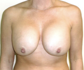 Breast Explant Before