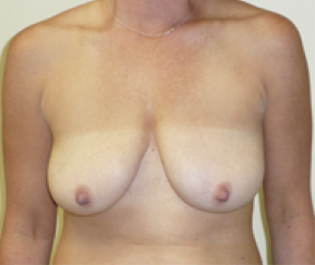 Breast Explant After