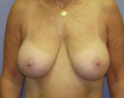 Breast Explant Before