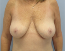 Breast Explant After