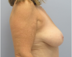 Breast Explant After