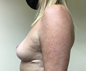 Breast Explant and Lift After