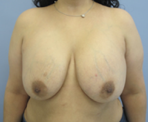 Breast Explant and Lift Before