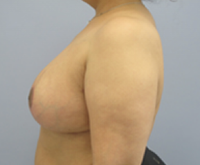 Breast Explant and Lift After