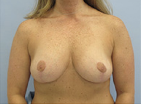 Breast Explant and Lift After