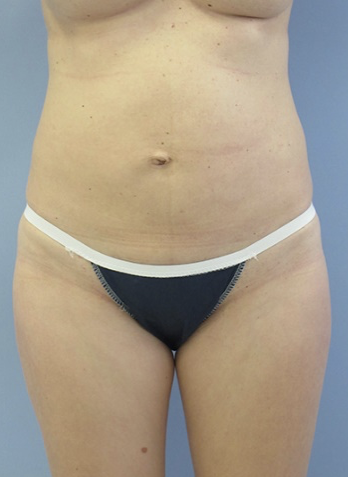 Tummy Tuck Before