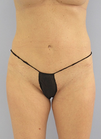 Tummy Tuck After