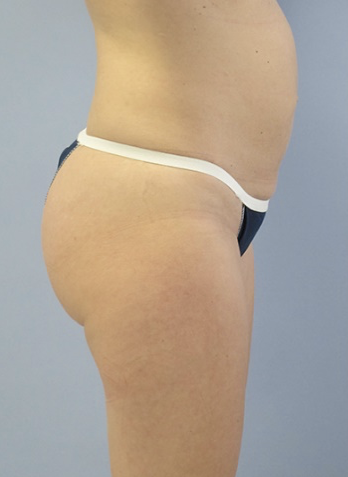 Tummy Tuck Before