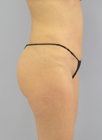 Tummy Tuck After